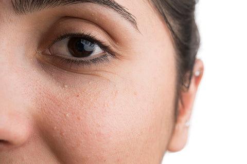 How to Get Rid Of Little White Milia Bumps